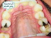 عصب کشی و ترمیم دندان اقساطی